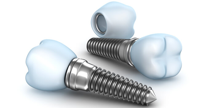 Everybody Smiles | Dental Implants