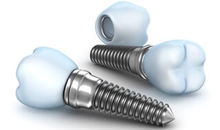Everybody Smiles | Dental Implants