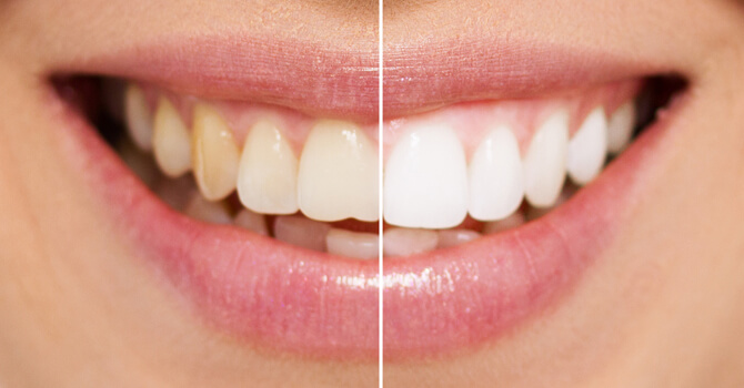 Everybody Smiles | Teeth Whitening