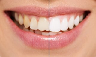 Everybody Smiles | Teeth Whitening